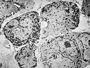 M, 16y. | acidophilic pituitary adenoma (STH)